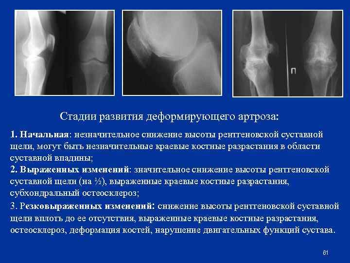 Какая рентгенологическая картина характерна для начальных форм коксартроза