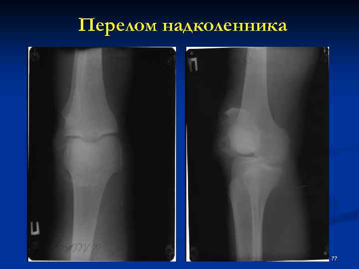 Перелом надколенника сроки. Переломы надколенника классификация. Кортикальный перелом надколенника. Краевой перелом верхушки надколенника. Переломы надколенника классификация рентген.