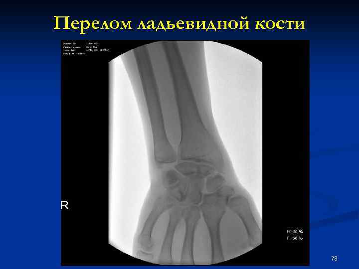 Перелом ладьевидной кости 78 