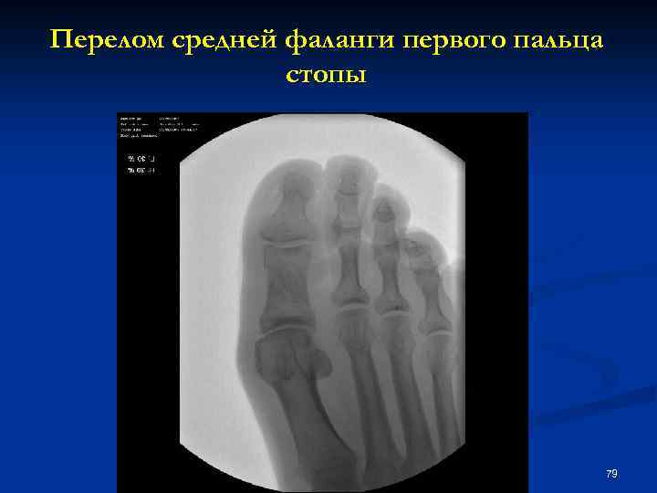 Перелом средней фаланги первого пальца стопы 79 