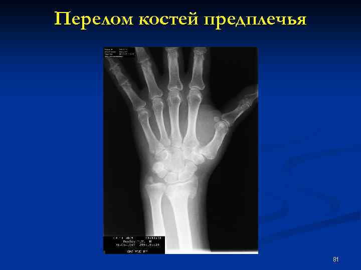 Перелом костей предплечья 81 
