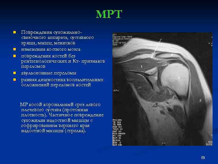 МРТ n n n Повреждения сухожильносвязочного аппарата, суставного хряща, мышц, менисков изменения костного мозга