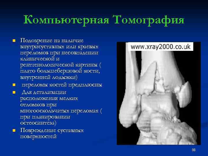 Компьютерная Томография n n Подозрение на наличие внутрисуставных или краевых переломов при несовпадении клинической
