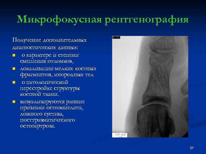 Микрофокусная рентгенография Получение дополнительных диагностических данных: n о характере и степени смещения отломков, n