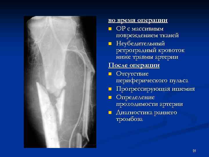 во время операции n ОР с массивным повреждением тканей n Неубедительный ретроградный кровоток ниже
