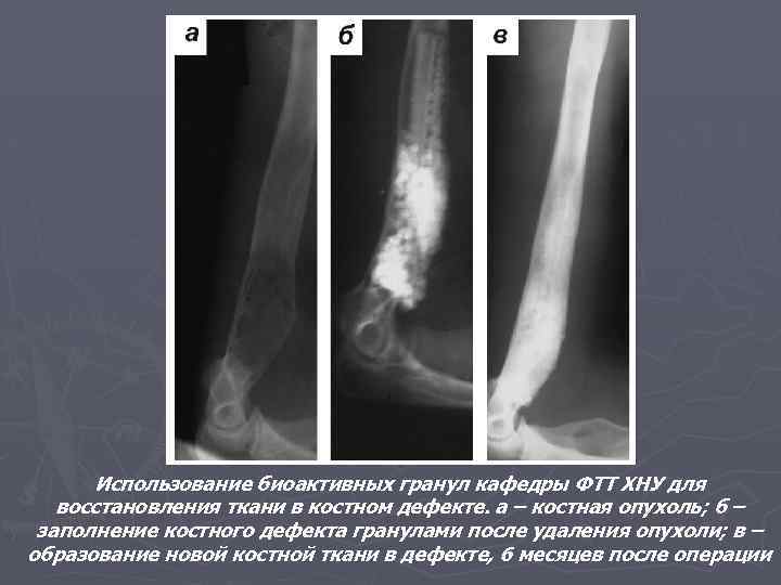 Использование биоактивных гранул кафедры ФТТ ХНУ для восстановления ткани в костном дефекте. а –