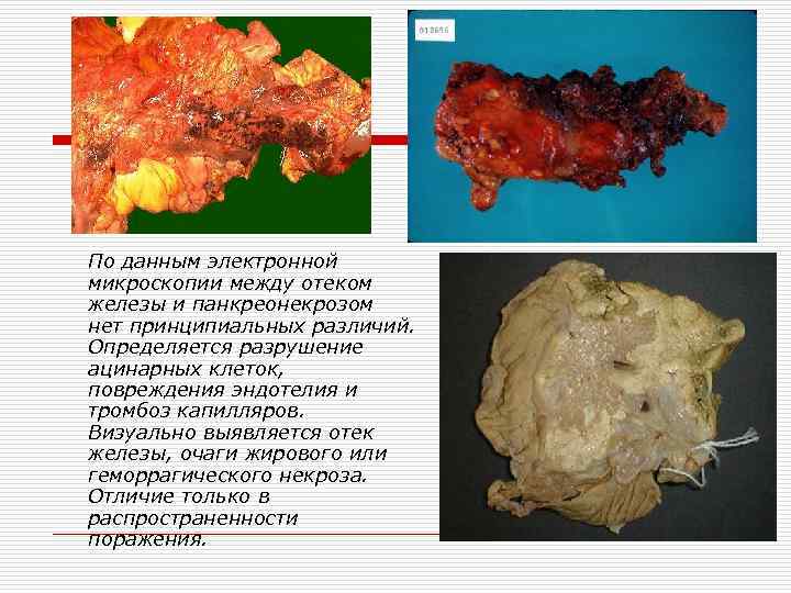 По данным электронной микроскопии между отеком железы и панкреонекрозом нет принципиальных различий. Определяется разрушение