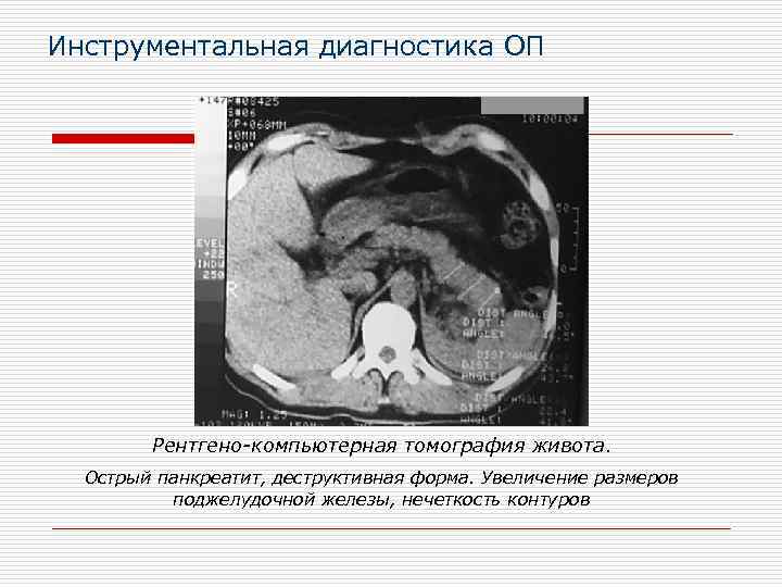 Инструментальная диагностика ОП Рентгено-компьютерная томография живота. Острый панкреатит, деструктивная форма. Увеличение размеров поджелудочной железы,