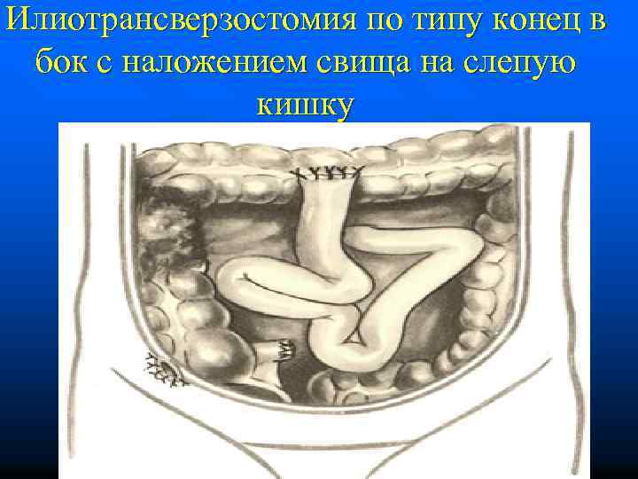 Илиотрансверзостомия по типу конец в бок с наложением свища на слепую кишку 