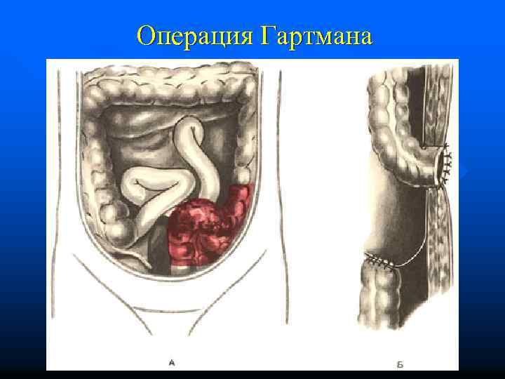 Операция Гартмана 