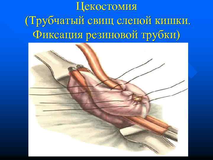 Цекостомия (Трубчатый свищ слепой кишки. Фиксация резиновой трубки) 