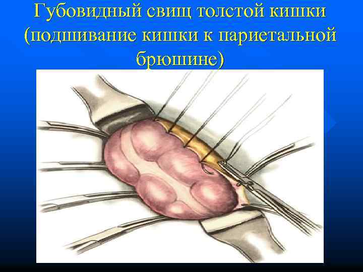 Губовидный свищ толстой кишки (подшивание кишки к париетальной брюшине) 