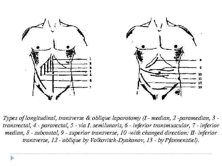 Types of longitudinal, transverse & oblique laparotomy (I - median, 2 -paramedian, 3 transrectal,