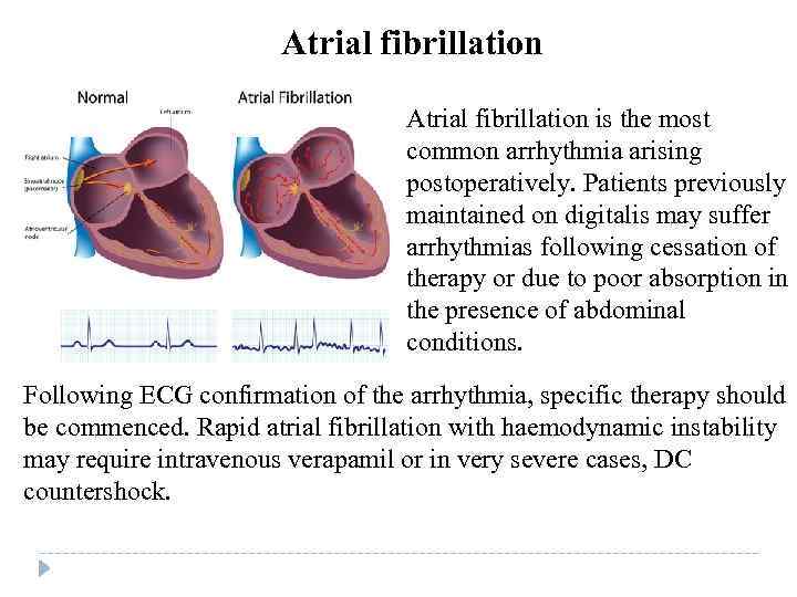 Atrial fibrillation is the most common arrhythmia arising postoperatively. Patients previously maintained on digitalis