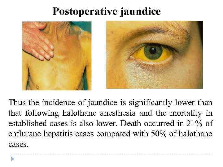 Postoperative jaundice Thus the incidence of jaundice is significantly lower than that following halothane