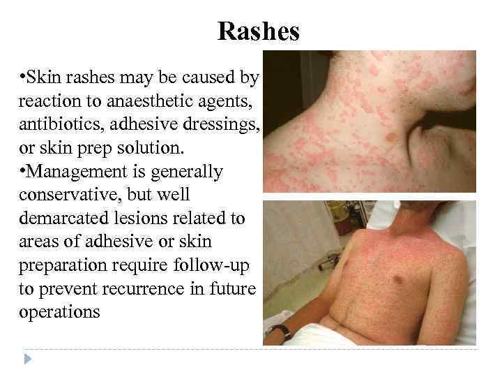 Rashes • Skin rashes may be caused by reaction to anaesthetic agents, antibiotics, adhesive