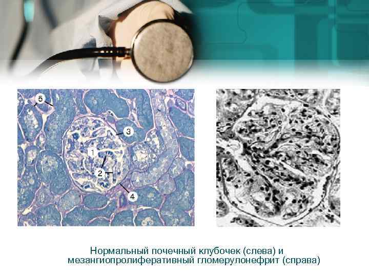 Нормальный почечный клубочек (слева) и мезангиопролиферативный гломерулонефрит (справа) 