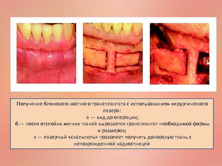 Получение блокового костного трансплантата с использованием хирургического лазера: а — вид до операции; б