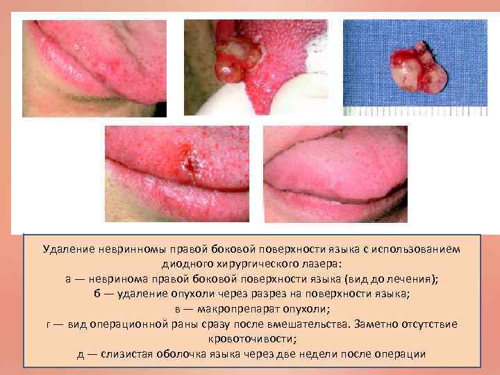 Удаление невринномы правой боковой поверхности языка с использованием диодного хирургического лазера: а — невринома