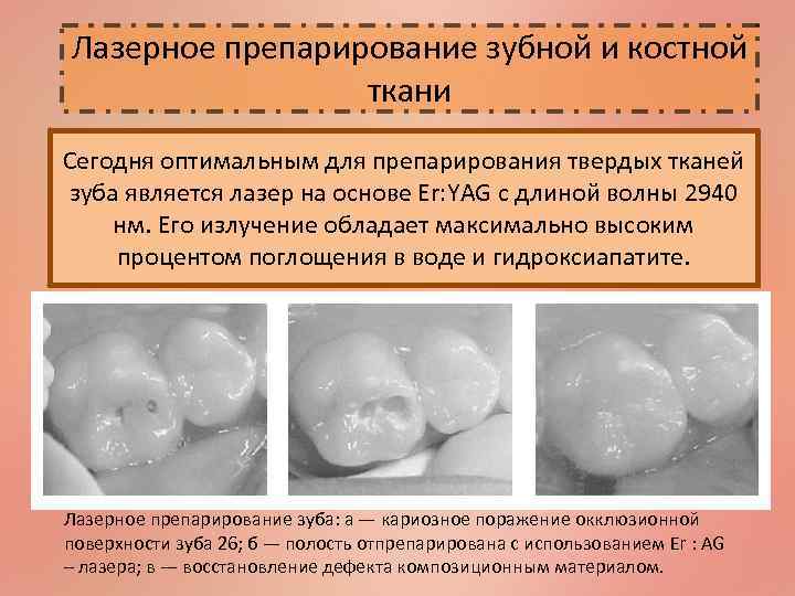 Лазерное препарирование зубной и костной ткани Сегодня оптимальным для препарирования твердых тканей зуба является