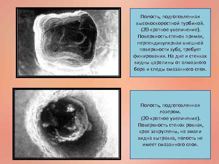 Полость, подготовленная высокоскоростной турбиной. (20 -кратное увеличение). Поверхность стенок прямая, перпендикулярная внешней поверхности зуба,