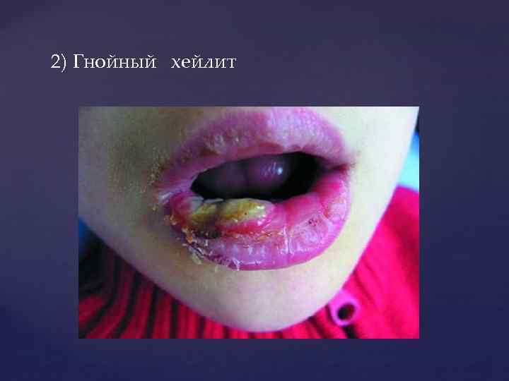 2) Гнойный хейлит 