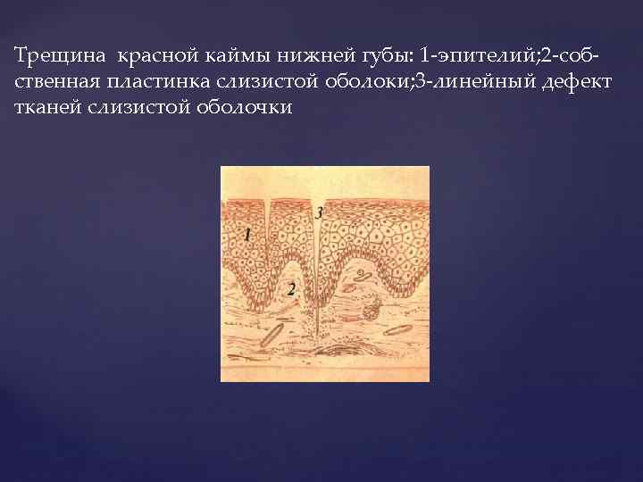 Трещина красной каймы нижней губы: 1 -эпителий; 2 -собственная пластинка слизистой оболоки; 3 -линейный