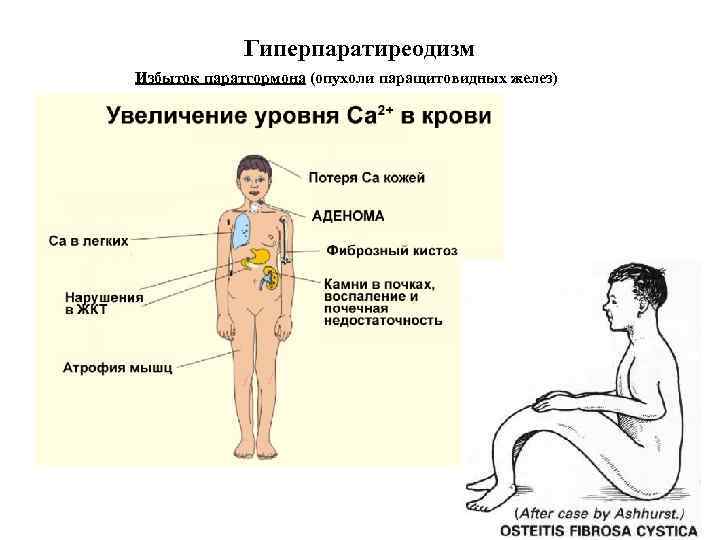 Гиперпаратиреодизм Избыток паратгормона (опухоли паращитовидных желез) 
