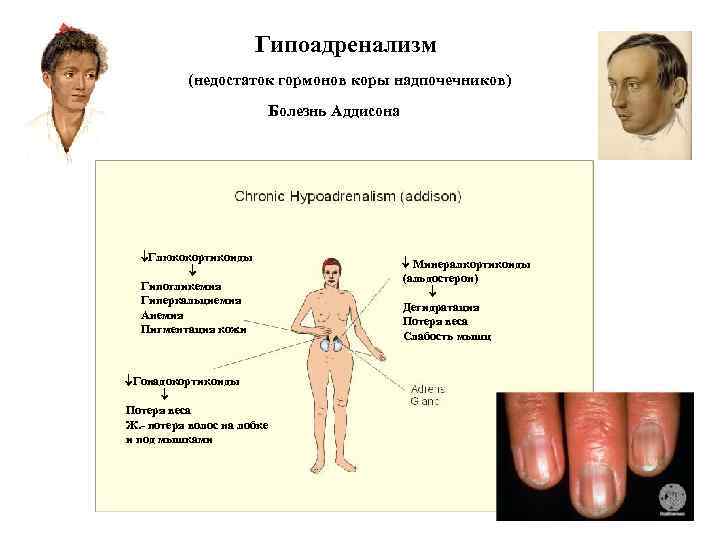 Недостаточность гормонов надпочечников