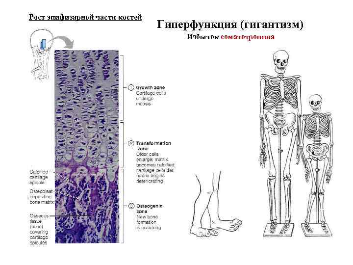 Рост эпифизарной части костей Гиперфункция (гигантизм) Избыток соматотропина 