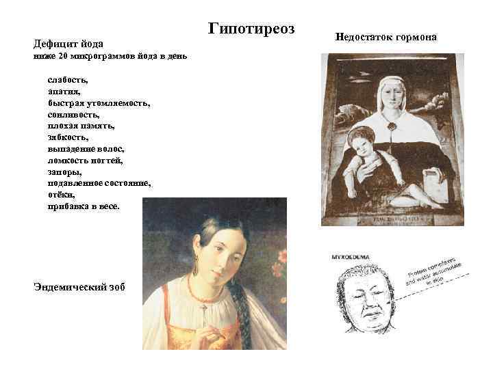 Гипотиреоз Дефицит йода ниже 20 микрограммов йода в день слабость, апатия, быстрая утомляемость, сонливость,