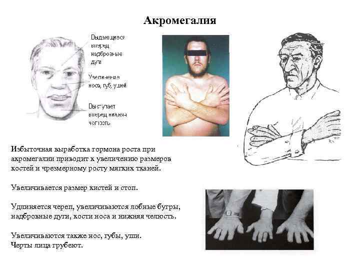 Акромегалия Избыточная выработка гормона роста при акромегалии приводит к увеличению размеров костей и чрезмерному