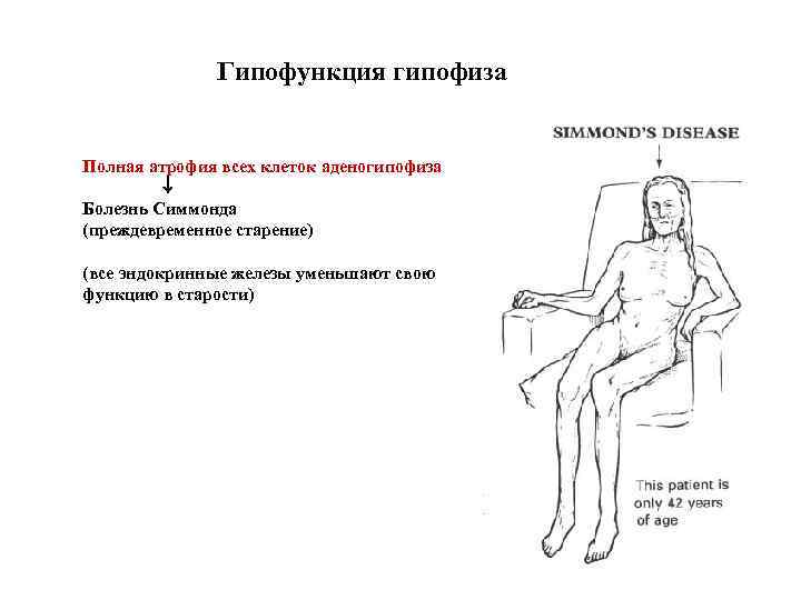 Синдром симмондса шиена презентация