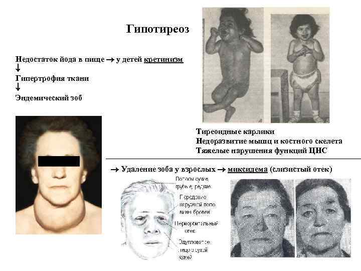 Гипотиреоз Недостаток йода в пище у детей кретинизм Гипертрофия ткани Эндемический зоб Тиреоидные карлики