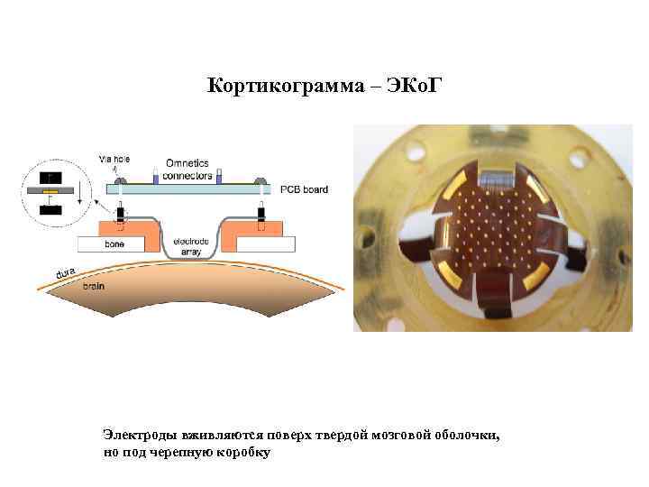 Кортикограмма – ЭКо. Г Электроды вживляются поверх твердой мозговой оболочки, но под черепную коробку