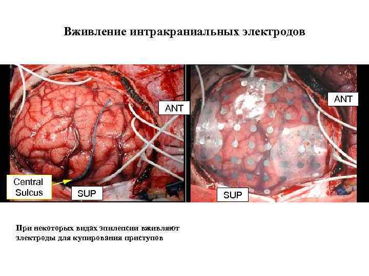 Вживление интракраниальных электродов ANT Central Sulcus SUP При некоторых видах эпилепсии вживляют электроды для