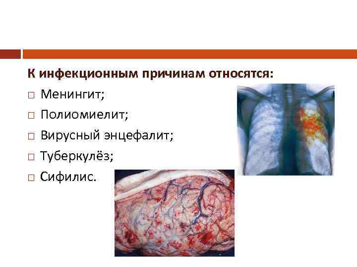 К инфекционным причинам относятся: Менингит; Полиомиелит; Вирусный энцефалит; Туберкулёз; Сифилис. 