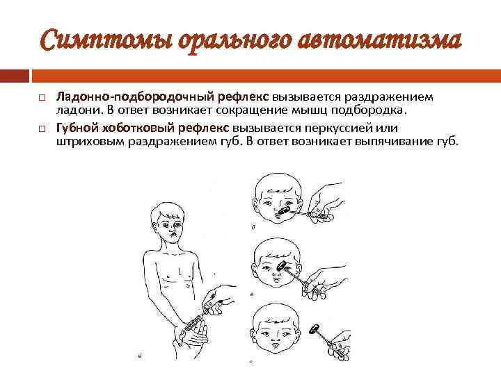 Симптомы орального автоматизма Ладонно-подбородочный рефлекс вызывается раздражением ладони. В ответ возникает сокращение мышц подбородка.