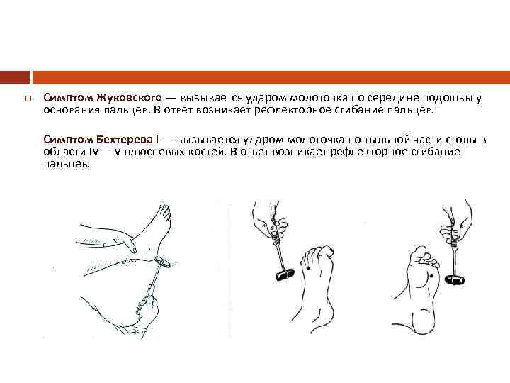  Симптом Жуковского — вызывается ударом молоточка по середине подошвы у основания пальцев. В