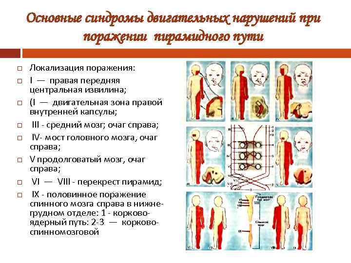 Основные синдромы двигательных нарушений при поражении пирамидного пути Локализация поражения: I — правая передняя