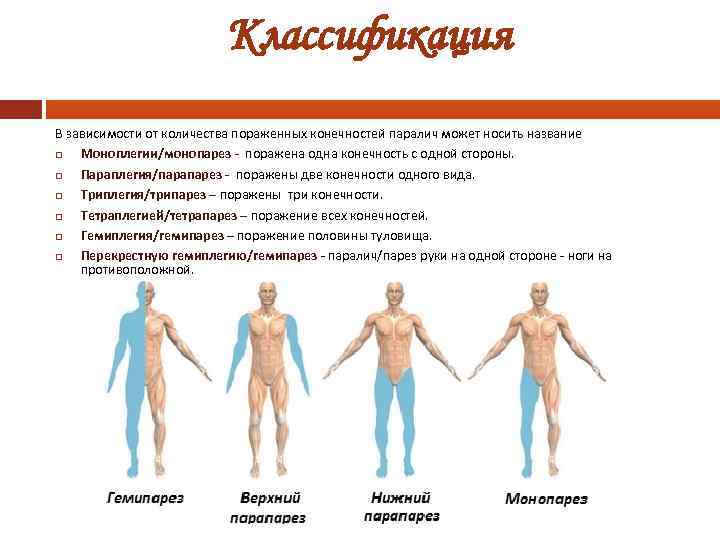 Классификация В зависимости от количества пораженных конечностей паралич может носить название Моноплегии/монопарез поражена одна