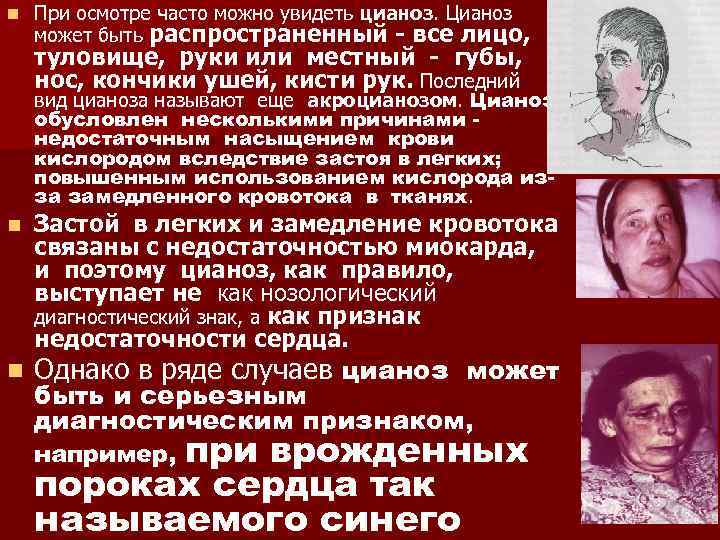 n При осмотре часто можно увидеть цианоз. Цианоз может быть распространенный - все лицо,