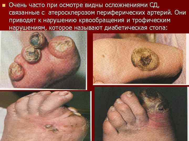 n Очень часто при осмотре видны осложнениями СД, связанные с атеросклерозом периферических артерий. Они