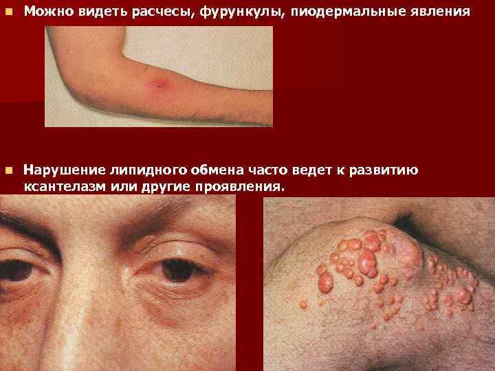 n Можно видеть расчесы, фурункулы, пиодермальные явления n Нарушение липидного обмена часто ведет к