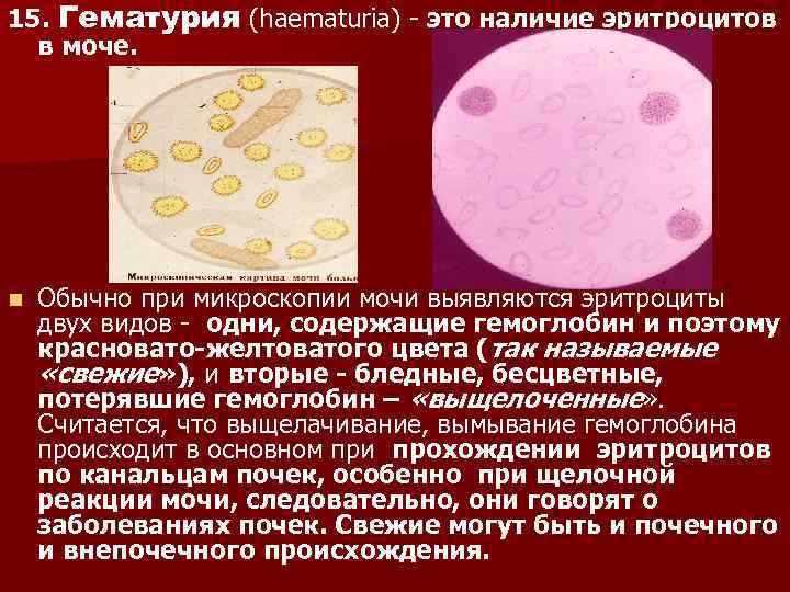 Сколько эритроцитов в моче. Эритроциты в моче микроскопия. Эритроциты выщелоченные микроскопия. Механизм появления выщелоченных эритроцитов в моче. Выщелоченные эритроциты в моче.
