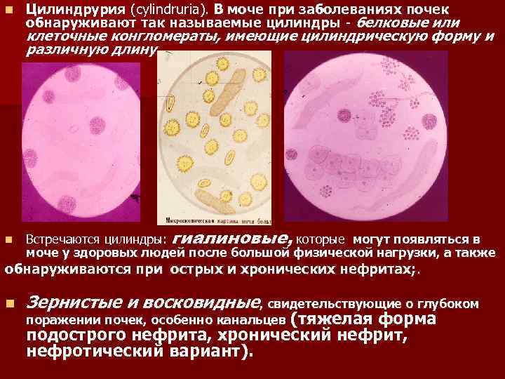 Лейкоцитурия наиболее характерный