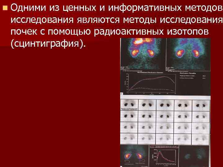 Функциональное исследование почек. Гамма сцинтиграфия почек. Самый информативный метод исследования почек. Физические методы исследования почек. Исследование почек изотопами.