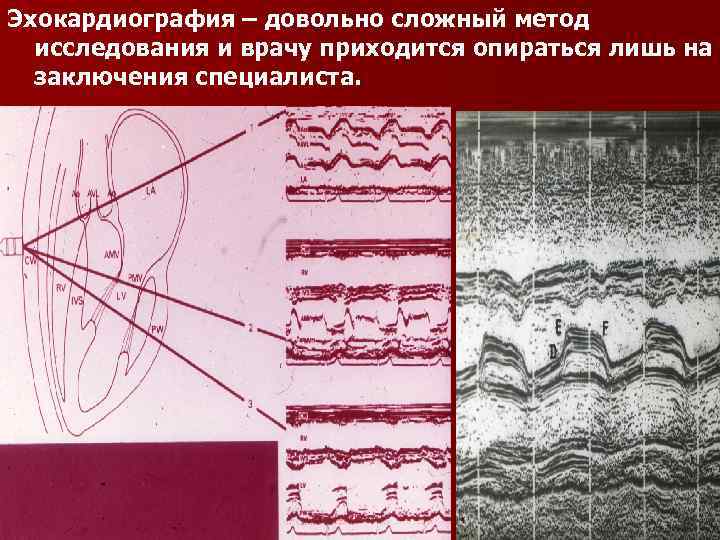 Эхокардиография – довольно сложный метод исследования и врачу приходится опираться лишь на заключения специалиста.