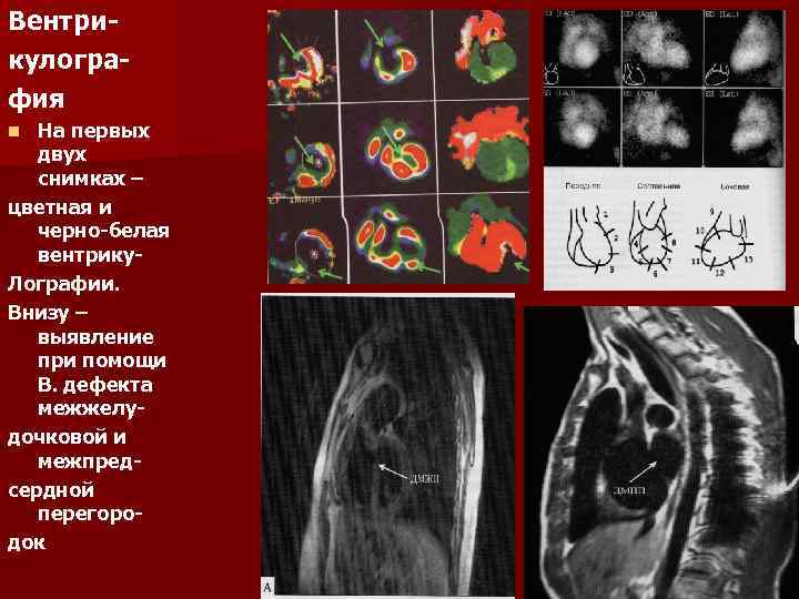 Вентрикулография На первых двух снимках – цветная и черно-белая вентрику. Лографии. Внизу – выявление