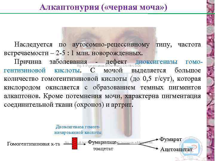 Алкаптонурия ( «черная моча» ) Наследуется по аутосомно-рецессивному типу, частота встречаемости – 2 -5